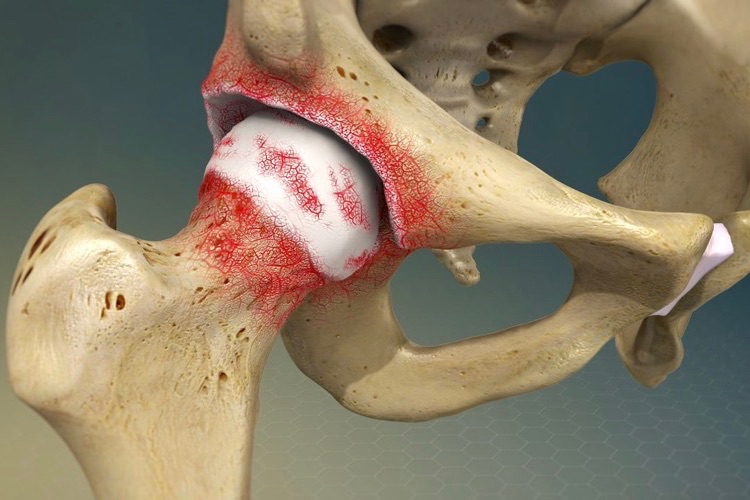 what causes Osteoarthritis