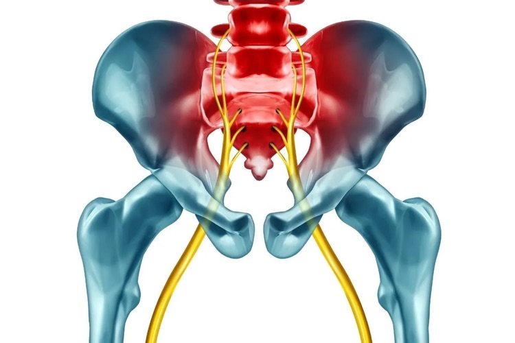 what causes sciatica