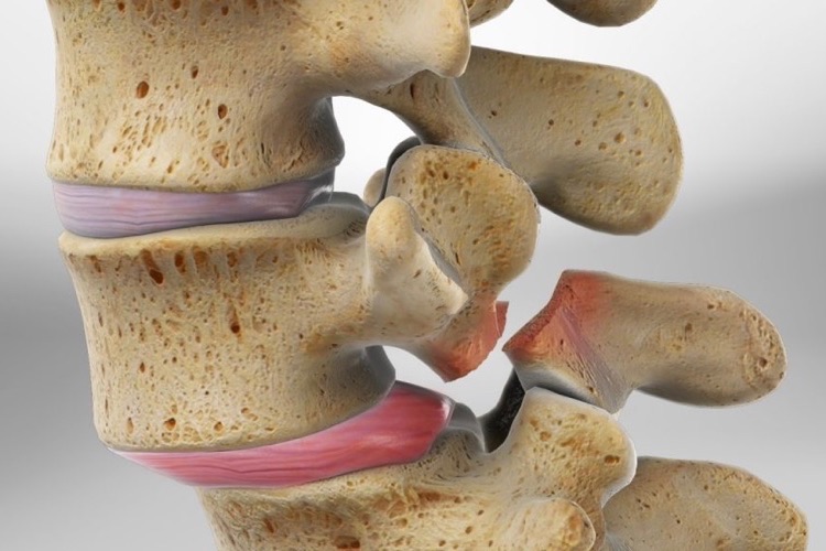 what is Spondylolisthesis